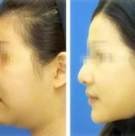 整容前后对比图,揭秘整容前后惊人对比